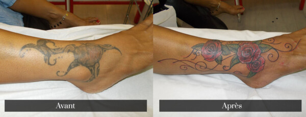 Recouvrement d'un tatouage sur la cheville